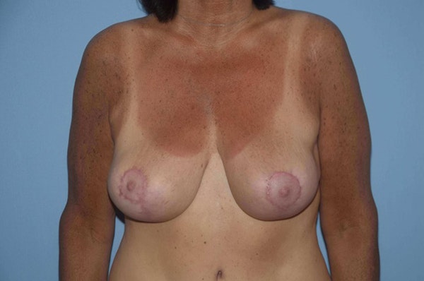 Breast Reduction Before & After Gallery - Patient 173566840 - Image 2