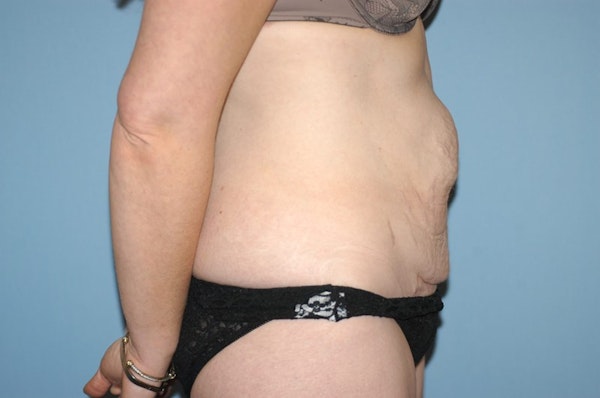 Tummy Tuck Before & After Gallery - Patient 173566737 - Image 5