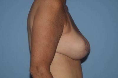 Breast Reduction Before & After Gallery - Patient 173566840 - Image 6