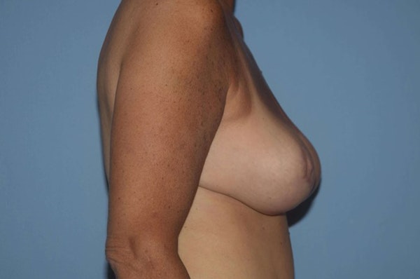 Breast Reduction Before & After Gallery - Patient 173566840 - Image 6