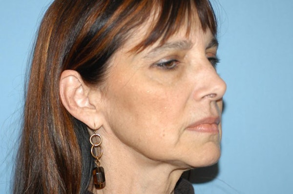 Facelift Before & After Gallery - Patient 173566994 - Image 3