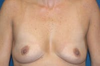 Breast Augmentation Before & After Gallery - Patient 173567067 - Image 1