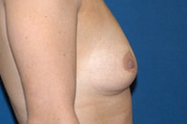 Breast Augmentation Before & After Gallery - Patient 173567067 - Image 5