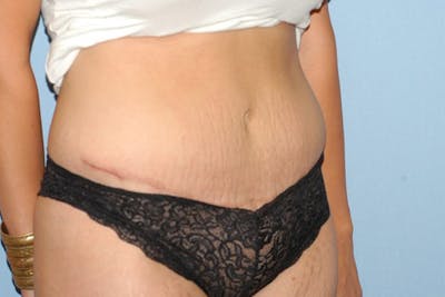 Tummy Tuck Before & After Gallery - Patient 173567068 - Image 4