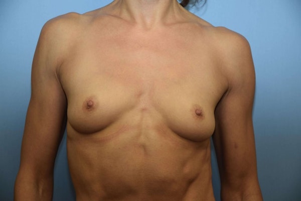 Breast Augmentation Before & After Gallery - Patient 173567071 - Image 1