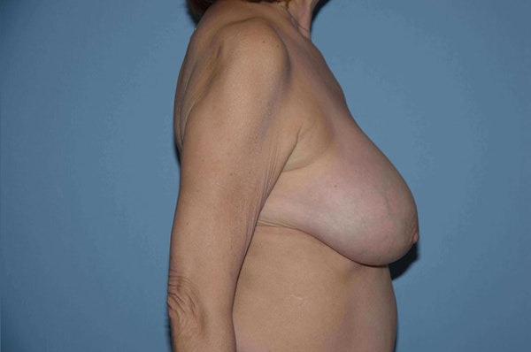 Breast Reduction Before & After Gallery - Patient 173567070 - Image 5