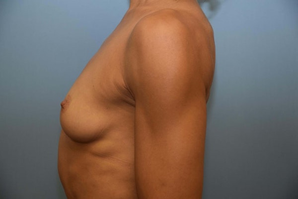 Breast Augmentation Before & After Gallery - Patient 173567071 - Image 5