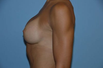 Breast Augmentation Before & After Gallery - Patient 173567071 - Image 6
