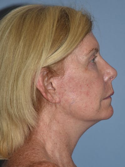Facelift Before & After Gallery - Patient 173567080 - Image 6