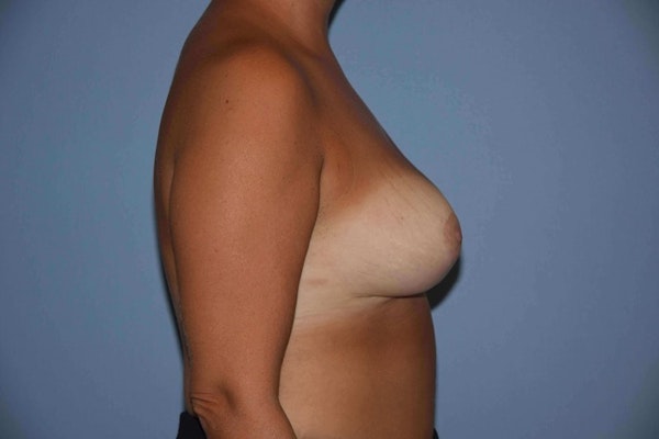 Breast Reduction Before & After Gallery - Patient 173567081 - Image 6