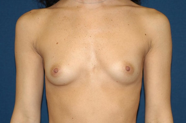 Breast Augmentation Before & After Gallery - Patient 173567092 - Image 1