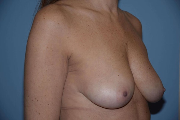 Breast Augmentation Before & After Gallery - Patient 173567096 - Image 3