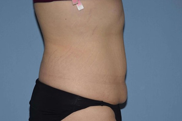 Tummy Tuck Before & After Gallery - Patient 173567097 - Image 5