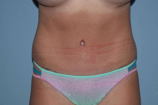 Tummy Tuck Before & After Gallery - Patient 173567105 - Image 2