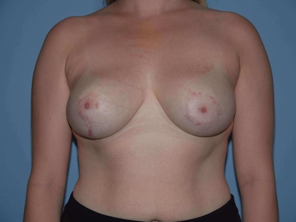 Breast Reduction Before & After Gallery - Patient 173567107 - Image 2