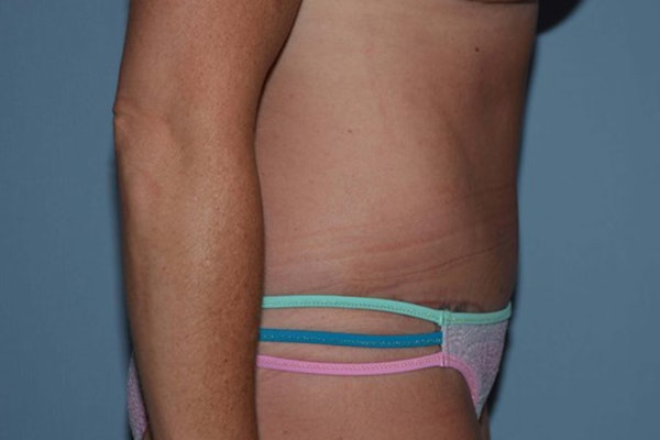 Tummy Tuck Before & After Gallery - Patient 173567105 - Image 6