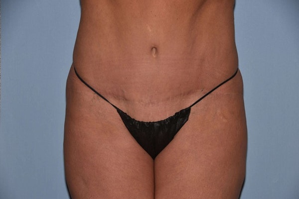 Tummy Tuck Before & After Gallery - Patient 173567112 - Image 2