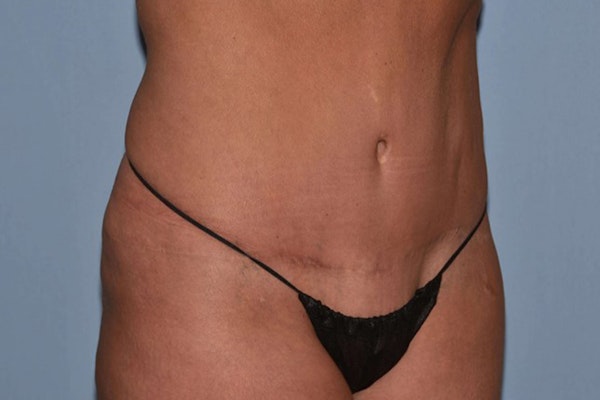 Tummy Tuck Before & After Gallery - Patient 173567112 - Image 4