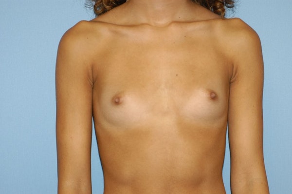 Breast Augmentation Before & After Gallery - Patient 173567115 - Image 1