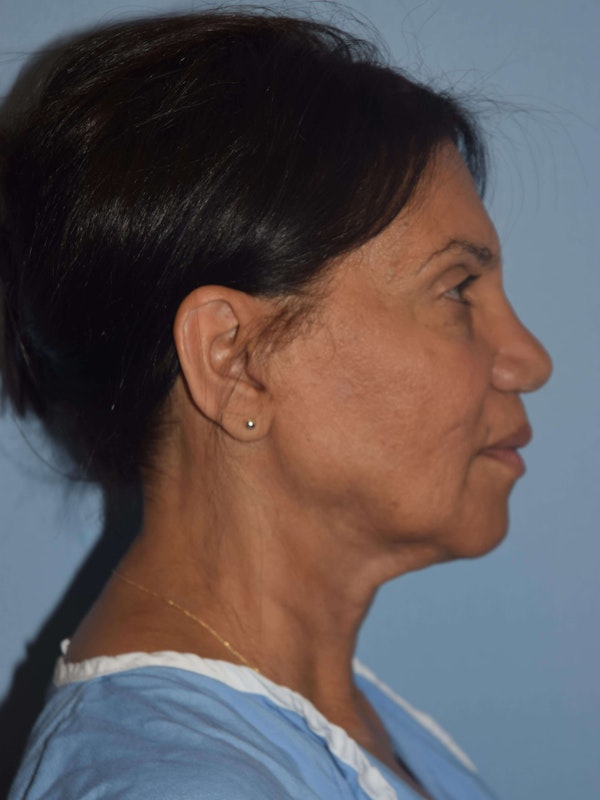 Facelift Before & After Gallery - Patient 173567114 - Image 5
