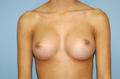 Breast Augmentation Before & After Gallery - Patient 173567115 - Image 2