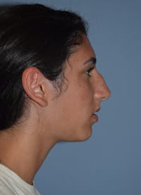 Rhinoplasty Before & After Gallery - Patient 173567149 - Image 1