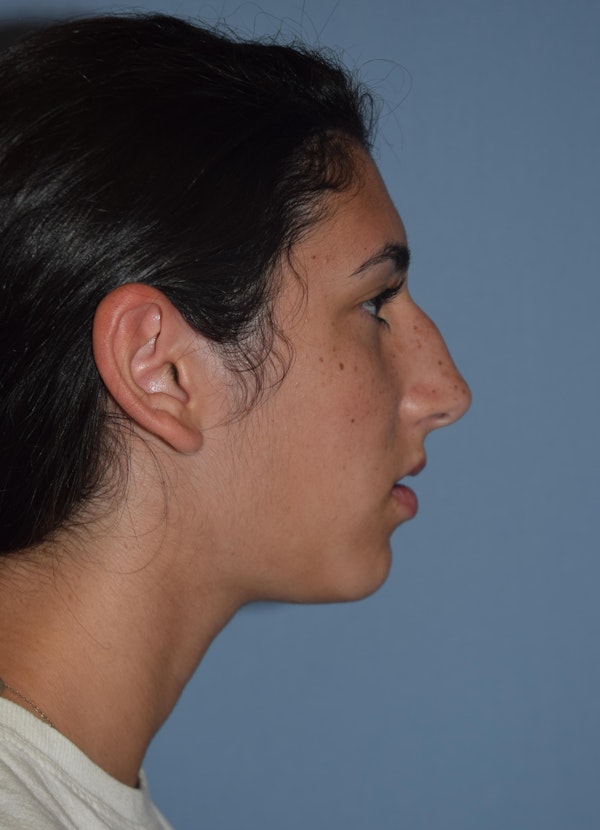 Rhinoplasty Before & After Gallery - Patient 173567149 - Image 1