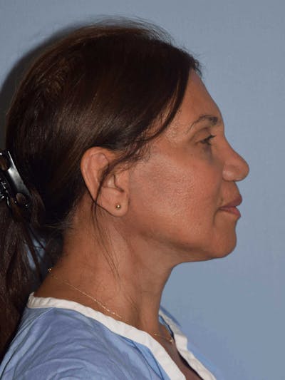 Facelift Before & After Gallery - Patient 173567114 - Image 6