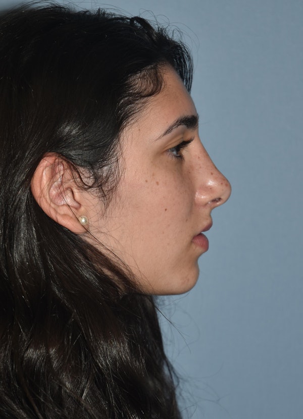Rhinoplasty Before & After Gallery - Patient 173567149 - Image 2