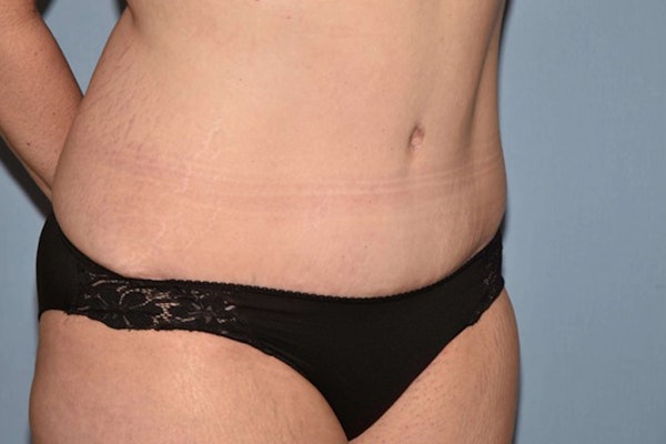 Tummy Tuck Before & After Gallery - Patient 173567117 - Image 4