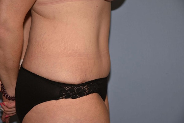 Tummy Tuck Before & After Gallery - Patient 173567117 - Image 6