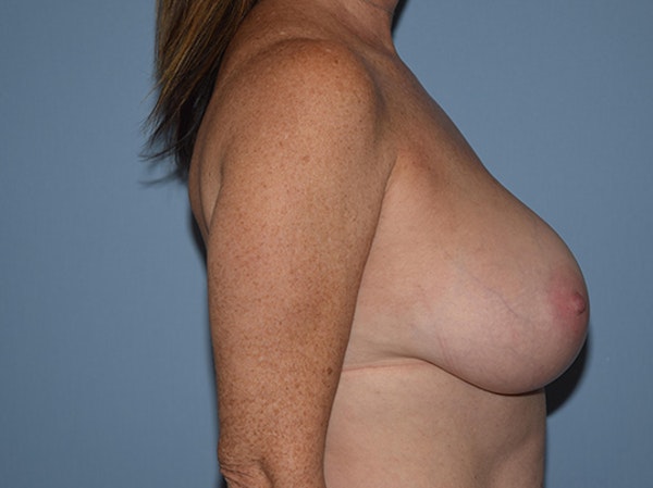 Breast Reduction Before & After Gallery - Patient 173567118 - Image 5