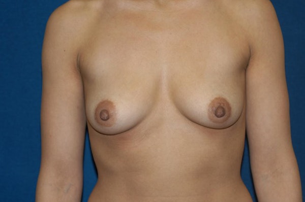 Breast Augmentation Before & After Gallery - Patient 173567122 - Image 1