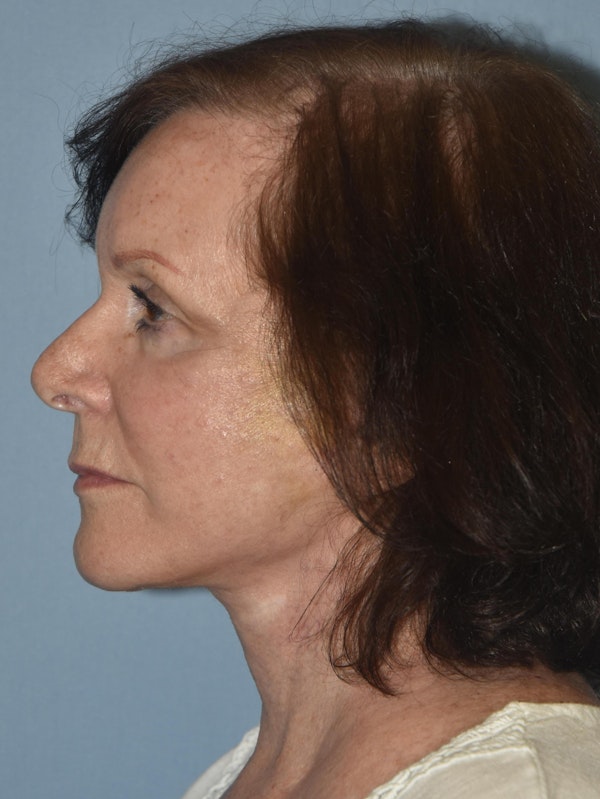Facelift Before & After Gallery - Patient 173567130 - Image 6