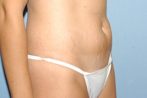 Tummy Tuck Before & After Gallery - Patient 173567131 - Image 3