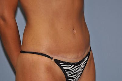 Tummy Tuck Before & After Gallery - Patient 173567131 - Image 4