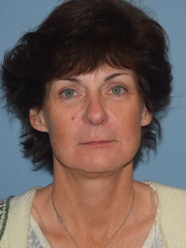 Facelift Before & After Gallery - Patient 173567138 - Image 2