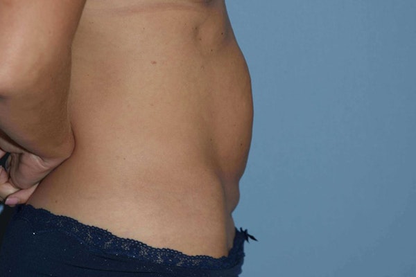 Tummy Tuck Before & After Gallery - Patient 173567134 - Image 3