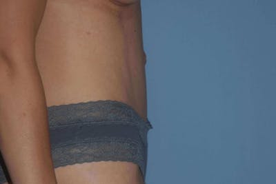 Tummy Tuck Before & After Gallery - Patient 173567134 - Image 4