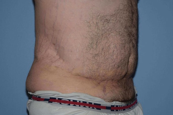 Tummy Tuck Before & After Gallery - Patient 173567147 - Image 3