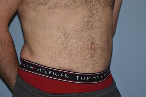 Tummy Tuck Before & After Gallery - Patient 173567147 - Image 4