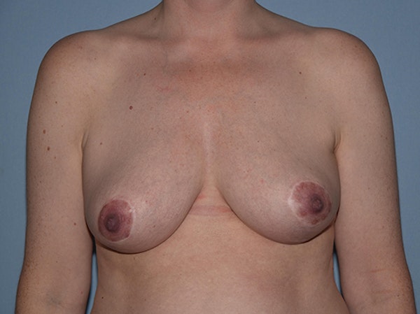 Breast Reduction Before & After Gallery - Patient 173567153 - Image 2