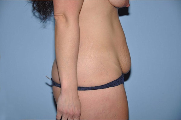 Tummy Tuck Before & After Gallery - Patient 173567380 - Image 5