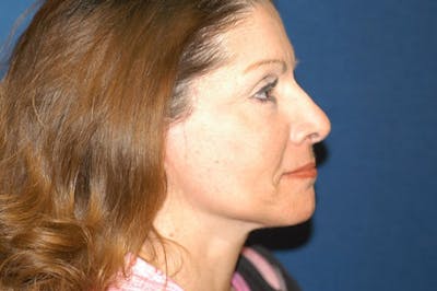 Facelift Before & After Gallery - Patient 173567429 - Image 4
