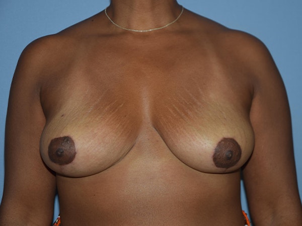 Breast Reduction Before & After Gallery - Patient 173567583 - Image 2