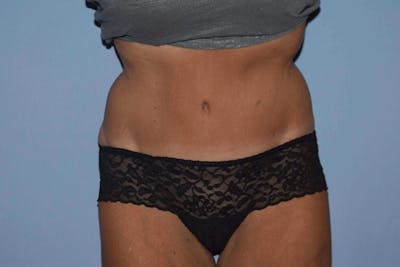 Tummy Tuck Before & After Gallery - Patient 173567615 - Image 2
