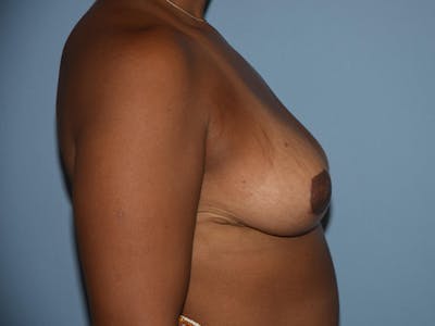 Breast Reduction Before & After Gallery - Patient 173567583 - Image 4