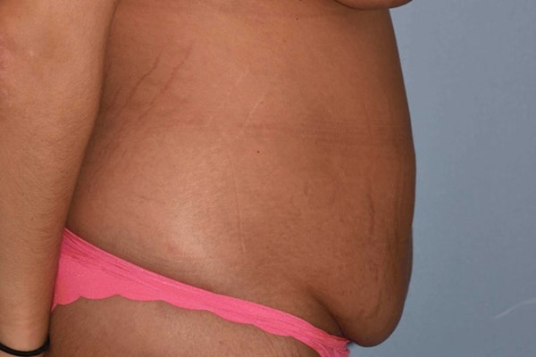 Tummy Tuck Before & After Gallery - Patient 173567714 - Image 3