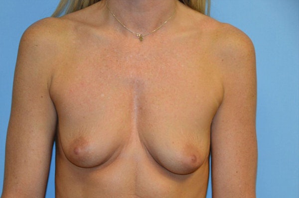 Breast Augmentation Before & After Gallery - Patient 173567718 - Image 1