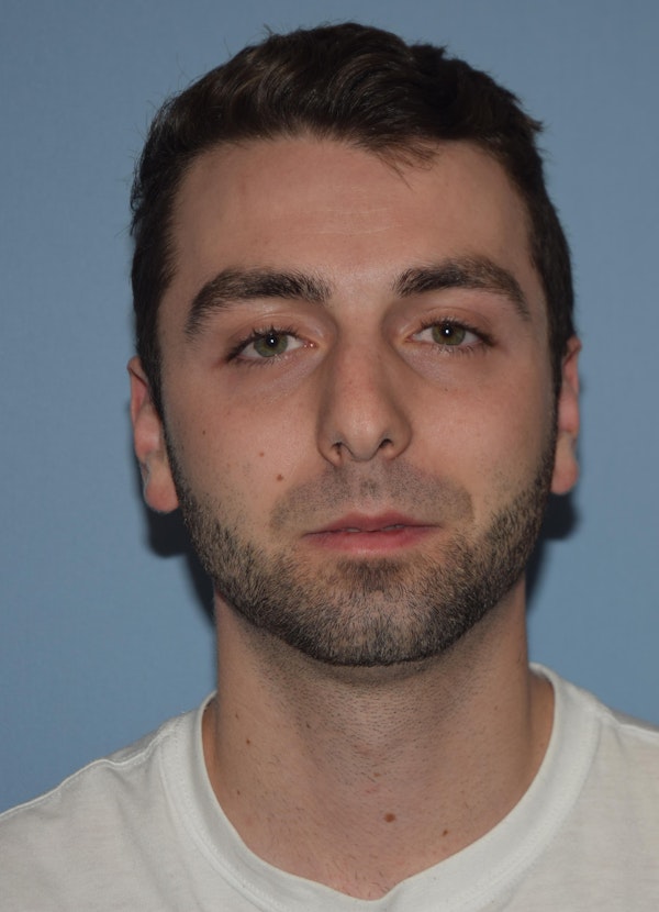 Rhinoplasty Before & After Gallery - Patient 173567723 - Image 3